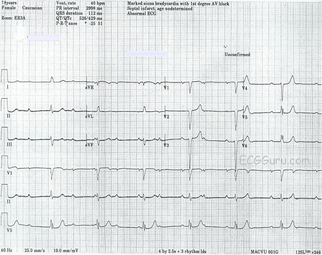 Complete AV Block With Junctional Escape Rhythm | ECG Guru - Instructor ...